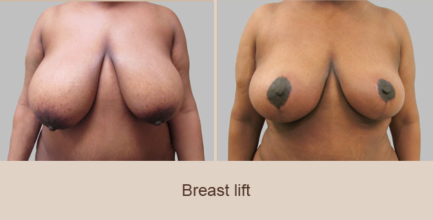 Before and After Image: Before and After Photos: Breast Augmentation and Lift - front