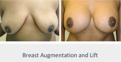 Before and After Image: Before and After Photos: Breast Augmentation and Lift - front