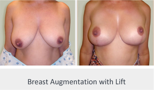 Before and After Image: Before and After Photos: Breast Augmentation and Lift - front