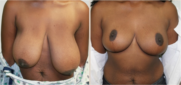 Before and After Image: Before and After Photos: Breast Augmentation and Lift - front
