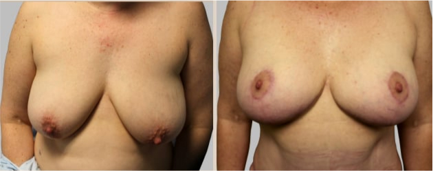Before and After Image: Before and After Photos: Breast Augmentation and Lift - front