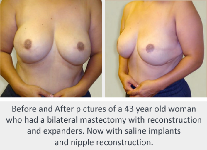 Before and After Image: Before and After Photos: Breast Reconstruction - front
