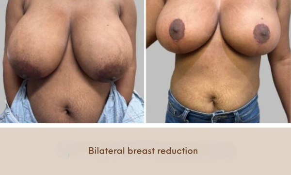 Before and After Image: Before and After Photos: Breast Reduction - front