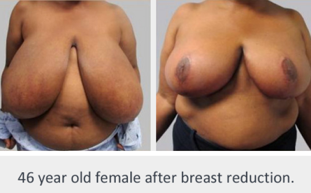Before and After Image: Before and After Photos: Breast Reduction - front