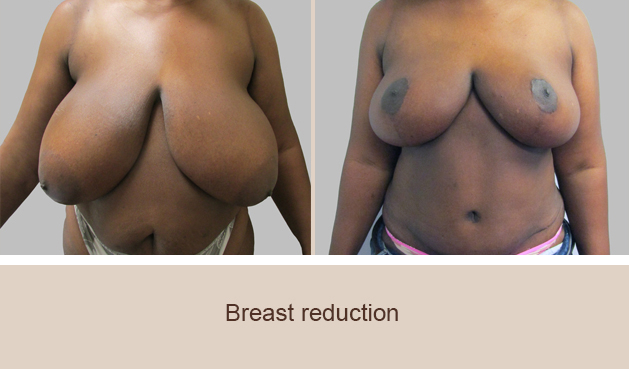 Before and After Image: Before and After Photos: Breast Reduction - front