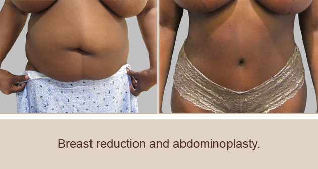 Before and After Image: Before and After Photos: Breast Reduction - front