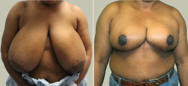 Before and After Image: Before and After Photos: Breast Reduction - front