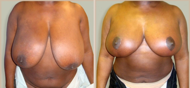 Before and After Image: Before and After Photos: Breast Reduction - front