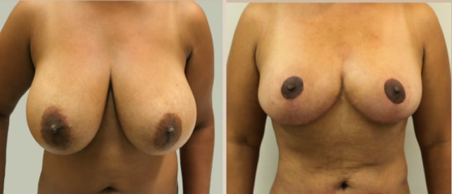 Before and After Image: Before and After Photos: Breast Reduction - front