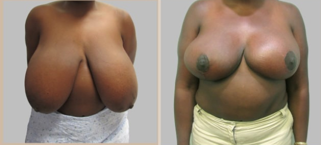 Before and After Image: Before and After Photos: Breast Reduction - front