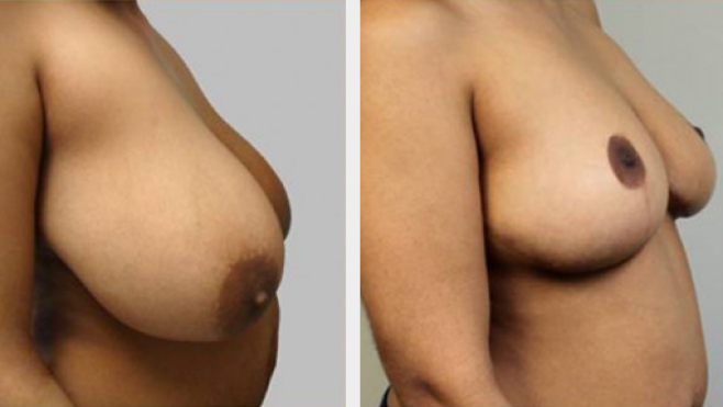 Before and After Image: Before and After Photos: Breast Reduction - right-side