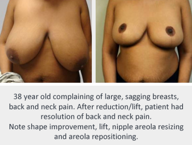Before and After Image: Before and After Photos: Breast Reduction - front