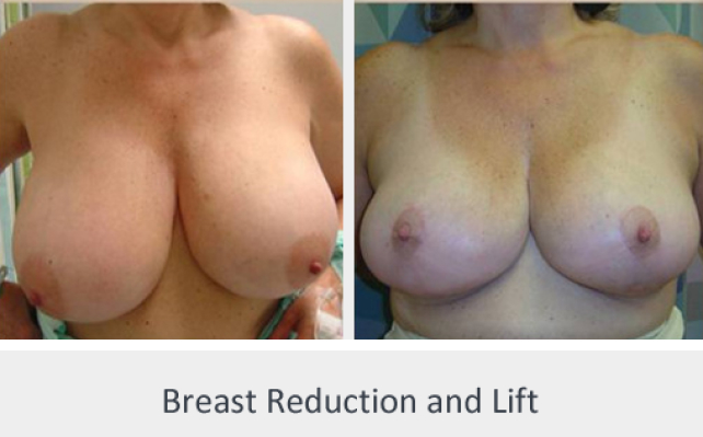 Before and After Image: Before and After Photos: Breast Reduction - front
