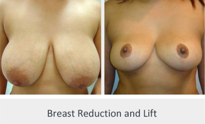Before and After Image: Before and After Photos: Breast Reduction - front
