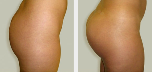 Before and After Image: Before and After Photos: Buttocks Implants - right-side