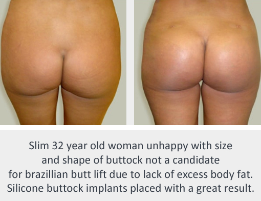 Before and After Image: Before and After Photos: Buttocks Implants - back