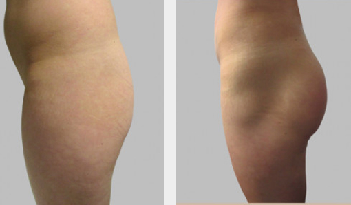Before and After Image: Before and After Photos: Buttocks Implants - left-side