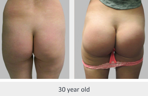 Before and After Image: Before and After Photos: Buttocks Implants - back