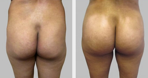 Before and After Image: Before and After Photos: Buttocks Implants - back
