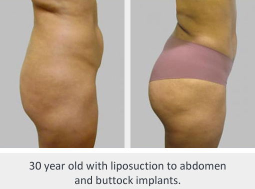 Before and After Image: Before and After Photos: Buttocks Implants - right-side