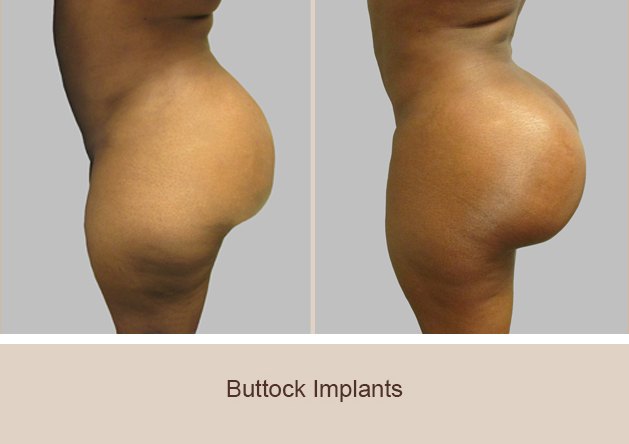 Before and After Image: Before and After Photos: Buttocks Implants - left-side