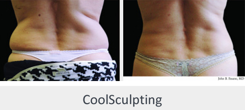 Before and After Image: Before and After Photos: CoolSculpting - back