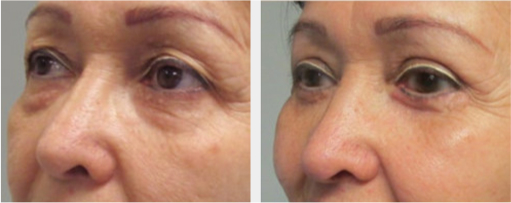 Before and After Image: Before and After Photos: Eyelid - front