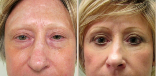 Before and After Image: Before and After Photos: Eyelid - front