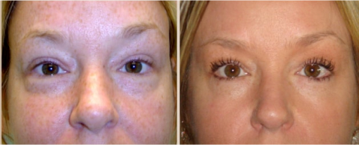 Before and After Image: Before and After Photos: Eyelid - front
