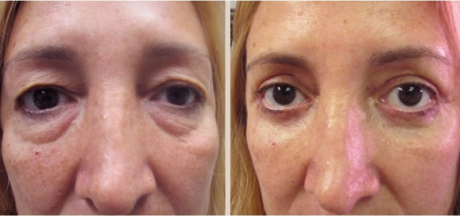 Before and After Image: Before and After Photos: Eyelid - front