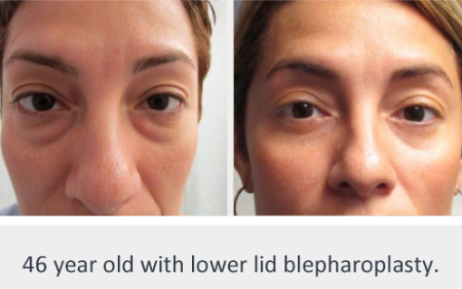 Before and After Image: Before and After Photos: Eyelid - front