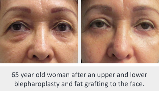 Before and After Image: Before and After Photos: Eyelid - front