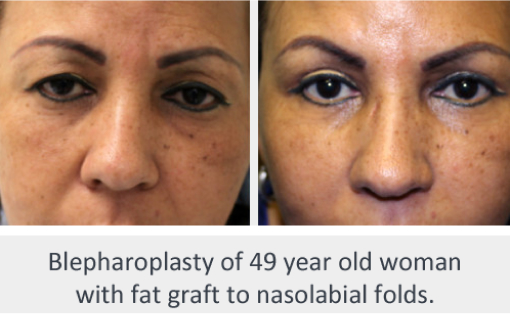 Before and After Image: Before and After Photos: Eyelid - front