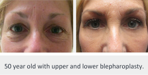 Before and After Image: Before and After Photos: Eyelid - front