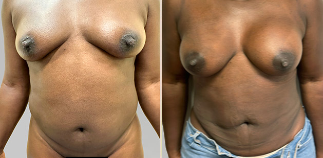 Before and After Image: Before and After Photos: Liposuction - front