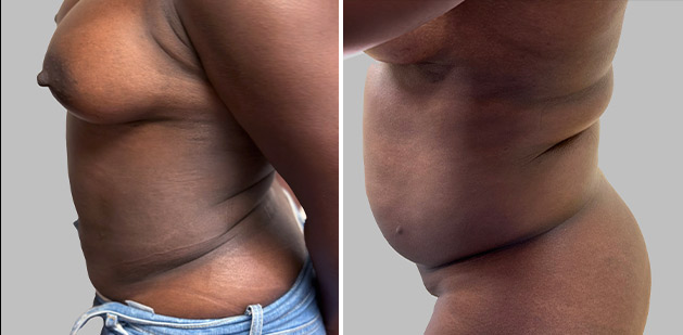 Before and After Image: Before and After Photos: Liposuction - left-side