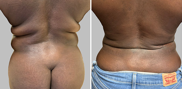 Before and After Image: Before and After Photos: Liposuction - back