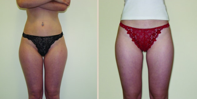Before and After Image: Before and After Photos: Liposuction - front