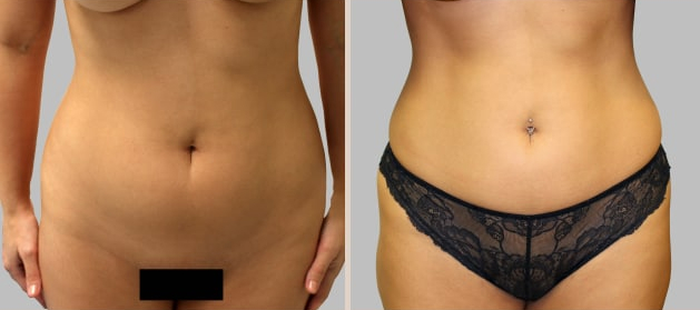 Before and After Image: Before and After Photos: Liposuction - front
