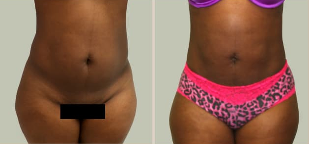 Before and After Image: Before and After Photos: Liposuction - front