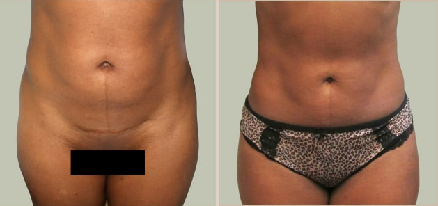 Before and After Image: Before and After Photos: Liposuction - front