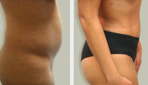 Before and After Image: Before and After Photos: Lipotherme™ - right-side