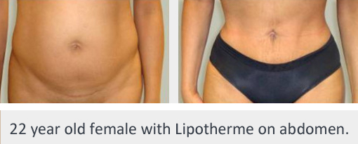 Before and After Image: Before and After Photos: Lipotherme™ - front