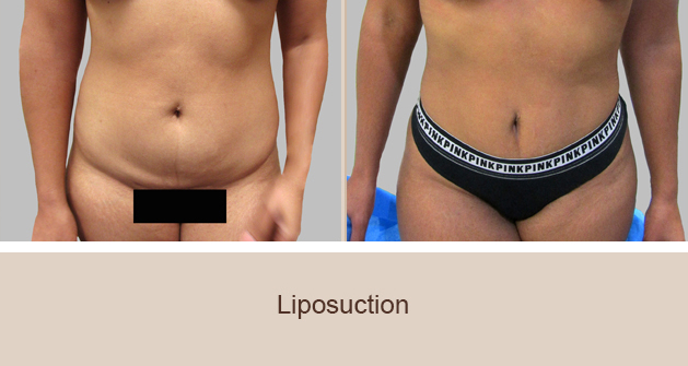 Before and After Image: Before and After Photos: Liposuction - front