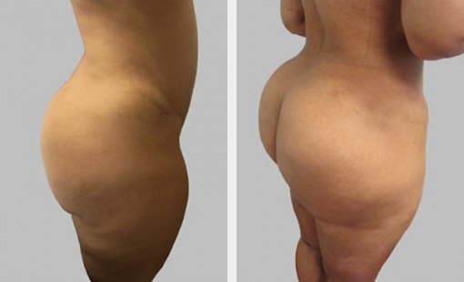 Before and After Image: Before and After Photos: Liposuction - right-back-oblique