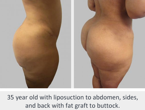 Before and After Image: Before and After Photos: Liposuction - right-back-oblique