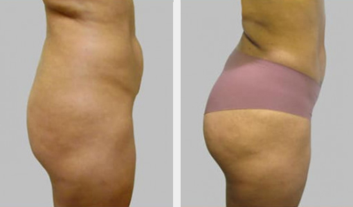 Before and After Image: Before and After Photos: Liposuction - right-side