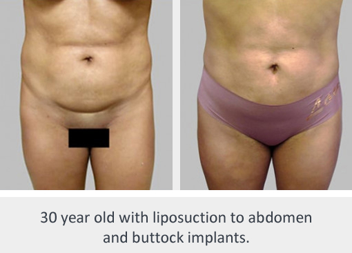 Before and After Image: Before and After Photos: Liposuction - front