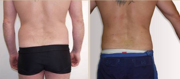 Before and After Image: Before and After Photos: Liposuction - back