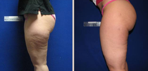 Before and After Image: Before and After Photos: Liposuction - left-side